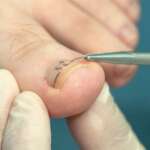Uñas encarnadas: causas, síntomas y cómo tratarlas correctamente en casa (y cuándo acudir al podólogo)